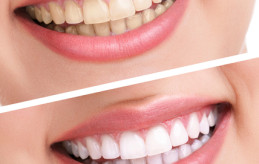before-and-after-dental-photo